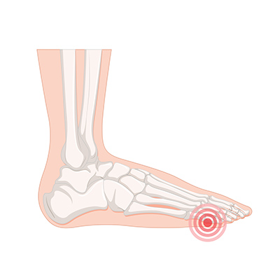 Hallux Valgus